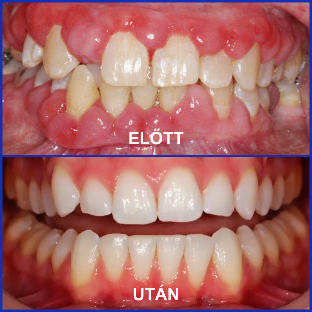 🌟Ščiti dlesni in krepi sklenino, zobna pasta za vsakodnevno ustno nego