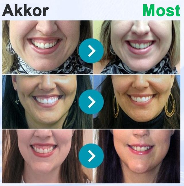 🌟Ščiti dlesni in krepi sklenino, zobna pasta za vsakodnevno ustno nego